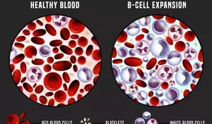 Understanding Chronic Leukemias: A Comprehensive Scientific Overview