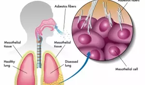 Understanding Mesothelioma: A Comprehensive Scientific Overview