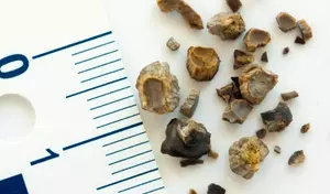 Understanding Kidney Stones: A Scientific and Technical Overview