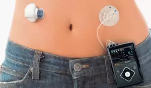 Insulin Pumps: A Comprehensive Guide to Understanding Continuous Insulin Delivery Systems