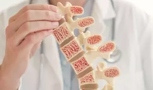 Understanding Osteoporosis: A Scientific and Technical Overview
