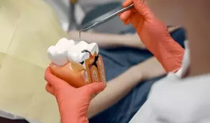 Root Canal Treatment: Understanding Dental Procedures for Tooth Preservation
