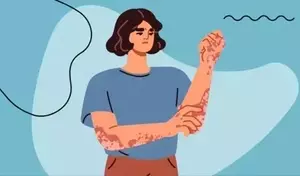 Understanding Eczema Treatment: A Comprehensive Scientific Overview