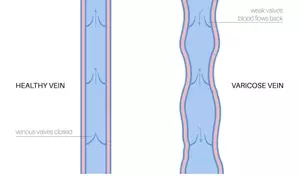 Understanding Varicose Vein Treatment: A Scientific and Technical Overview