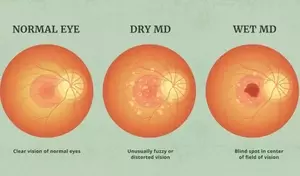 Understanding Macular Degeneration Treatment: A Comprehensive Clinical Overview