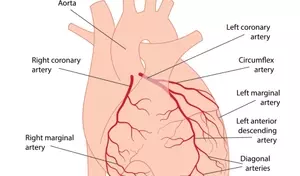 Understanding Coronary Artery Disease: A Comprehensive Scientific Overview