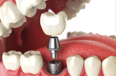 How to Find and Prepare for Quick Dental Implants Near You