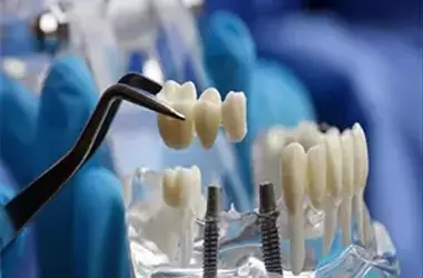 解放您的笑容：香港老年人一日全口牙齒植入