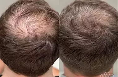 Exploring Hair Growth Supplements and Hair Transplant Options Locally and Abroad