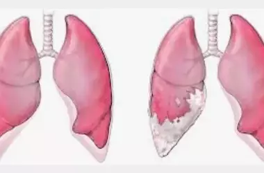Addressing Mesothelioma: Understanding, Prevention, and Treatment