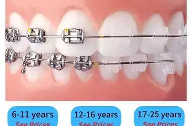 Smile with Confidence: Transformative Braces for a Beautiful, Straighter Smile