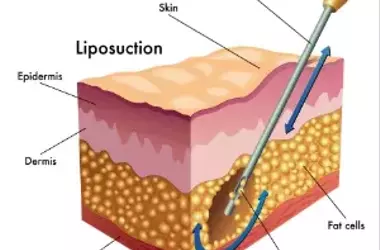 Sculpt Your Body: The Ultimate Guide to Liposuction Techniques and Innovations