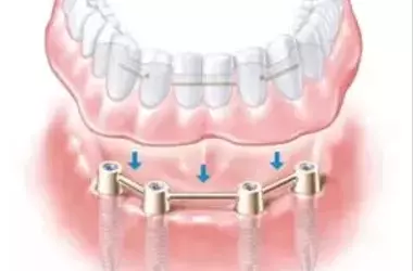 Why do dentists recommend dental implants?