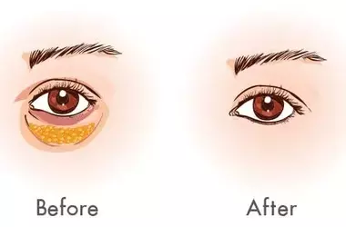 Improve Eye Bags: Learn About Blepharoplasty Guide