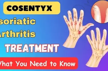 Learn about a comprehensive approach to treating psoriatic arthritis