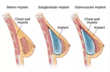 Exploring Options for Breast Enlargement