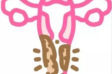 Say goodbye to itching in 3 days: the ultimate self-help guide for vaginitis