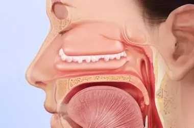 Nasal polyps – Symptoms, causes, and management
