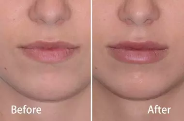 Kissable Confidence: Everything You Need to Know About Juvederm Lip Filler