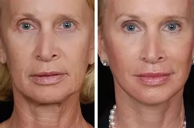 Rediscover Your Radiance: The Ultimate Guide to Rhytidectomy (Facelift)