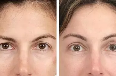 Forehead Lift: Elevate Your Look with Browplasty