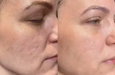 Radio Frequency Skin Tightening: A Non-Invasive Path to Firmer Skin