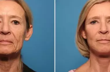 Facelifts Trials: A Low-Cost Pathway to Cutting-Edge Lifting Techniques