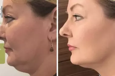 Ensayos de Lifting Facial: Una vía de bajo costo hacia técnicas de rejuvenecimiento de vanguardia