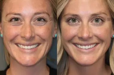 Wrinkle Removal: Exploring Options from Skincare to Surgery