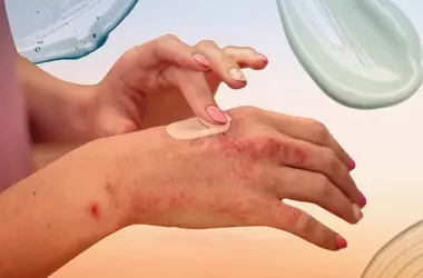 Psoriasis Treatment Uncovered: From Skincare to Cutting-Edge Biologics