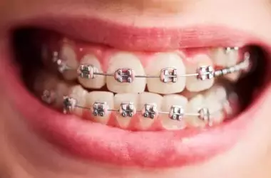 The rise of dental clips for teeth: What you need to know