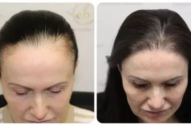 Hair Transplant: Restore Your Hair & Confidence. See Stunning Before & After Results!