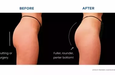Bigger Butt Without Surgery: Non-Surgical Methods to Enhance Your Curves