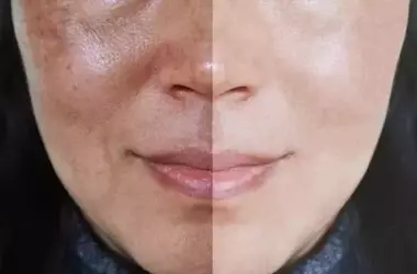 Melasma Treatment Near Me: Find the Best Options for Clearer Skin