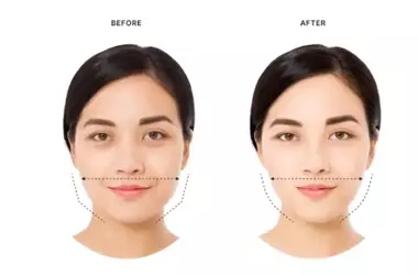 Masseter Botox: A Non-Surgical Solution for Jawline Slimming and Relief