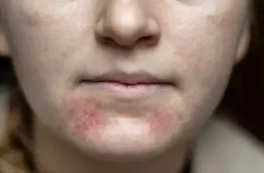 Dermatite Periorale: Comprensione e Gestione di un Disturbo Cutaneo Comune