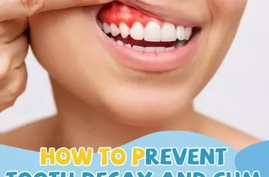 How to Prevent Tooth Decay and Gum Disease Naturally