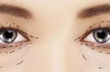 What is Blepharoplasty? Causes, Indications, and Aftercare Guide