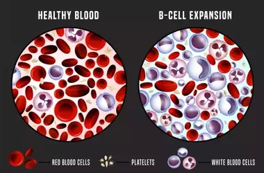 Understanding Chronic Leukemias: A Comprehensive Scientific Overview