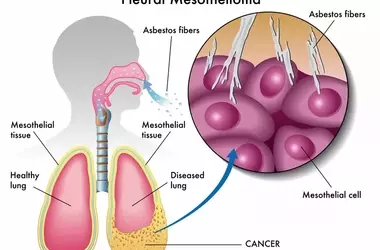 Understanding Mesothelioma: A Comprehensive Scientific Overview