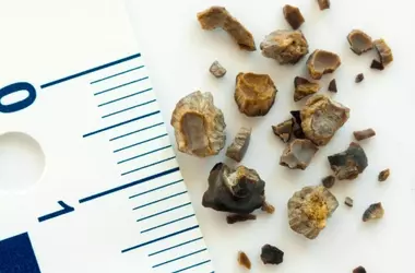 Understanding Kidney Stones: A Scientific and Technical Overview