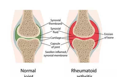 Understanding Rheumatoid Arthritis Treatment: A Comprehensive Scientific Overview