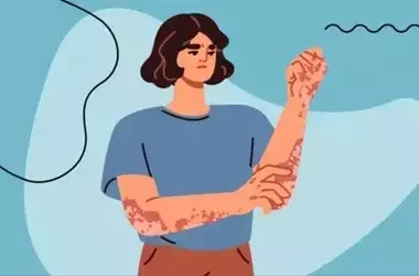 Understanding Eczema Treatment: A Comprehensive Scientific Overview