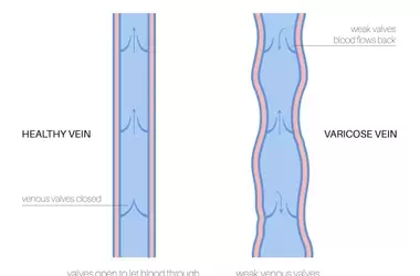 Understanding Varicose Vein Treatment: A Scientific and Technical Overview