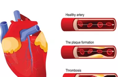 Understanding Coronary Heart Disease Treatment: A Comprehensive Clinical Overview