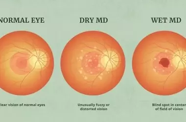 Understanding Macular Degeneration Treatment: A Comprehensive Clinical Overview