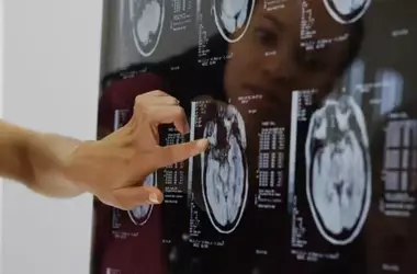 Unraveling the Paradox: How Cancer May Offer Protection Against Alzheimer's