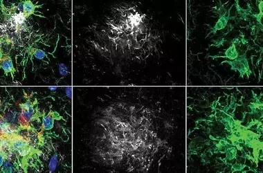 New Pathway for Alzheimer's Treatment Through Diabetes-Linked Enzyme