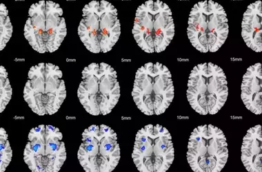 Brain Scans Uncover Two Distinct ADHD Subtypes