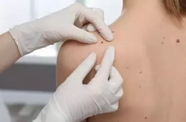 Melanoma: l'importanza della prevenzione e dell'individuazione precoce